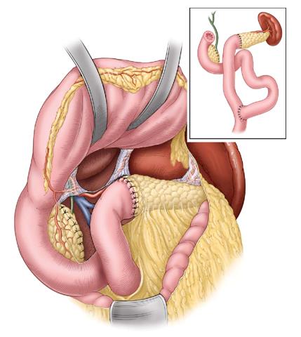 小撞击可能有大隐患 被方向盘撞到腹部后应警惕胰腺内伤