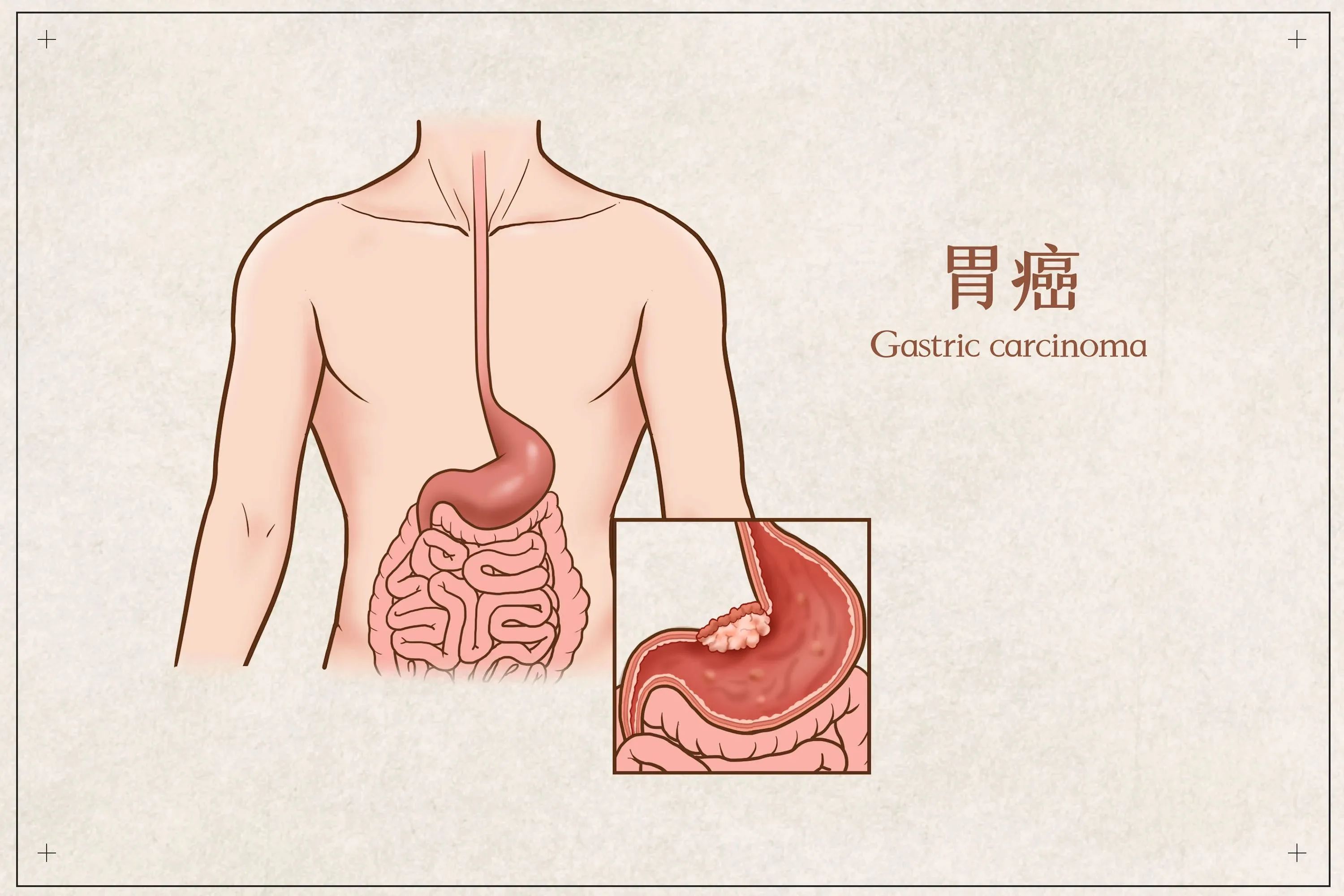 胃癌防治宣传月 | 胃，你好吗？我该如何守护你？