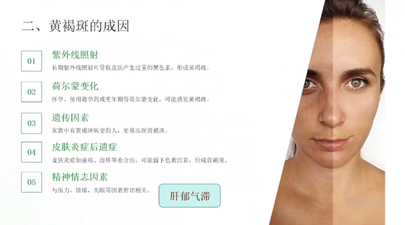 科普慕课｜黄褐斑防治，中医内外调理有妙招