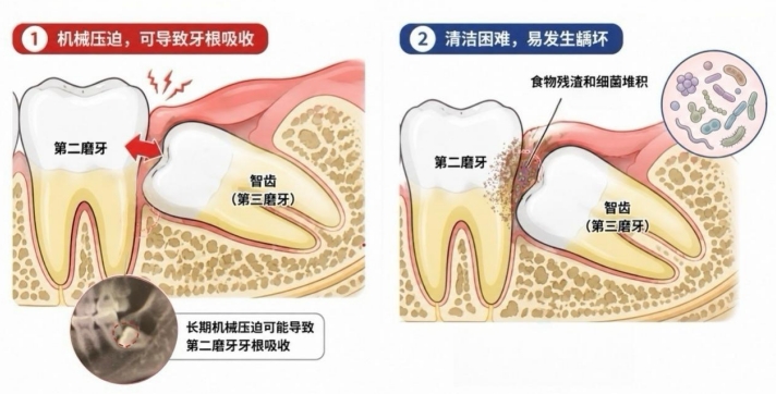 智齿不疼就无需处理？无痛智齿也存在隐匿口腔风险