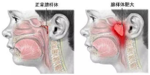 警惕！这种病影响孩子一生的颜值