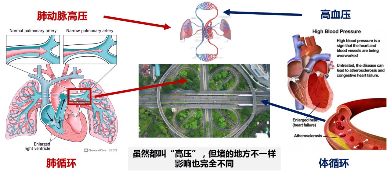 关于肺动脉高压的“真相”，这场科普直播一次全讲透了