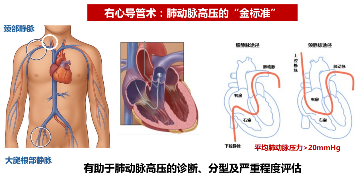 关于肺动脉高压的“真相”，这场科普直播一次全讲透了