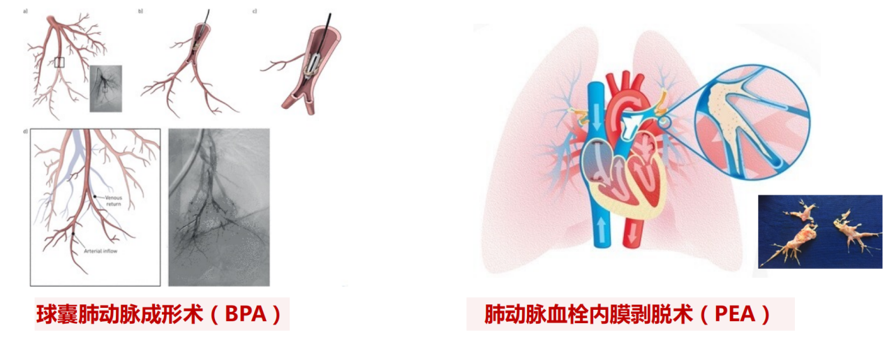 关于肺动脉高压的“真相”，这场科普直播一次全讲透了